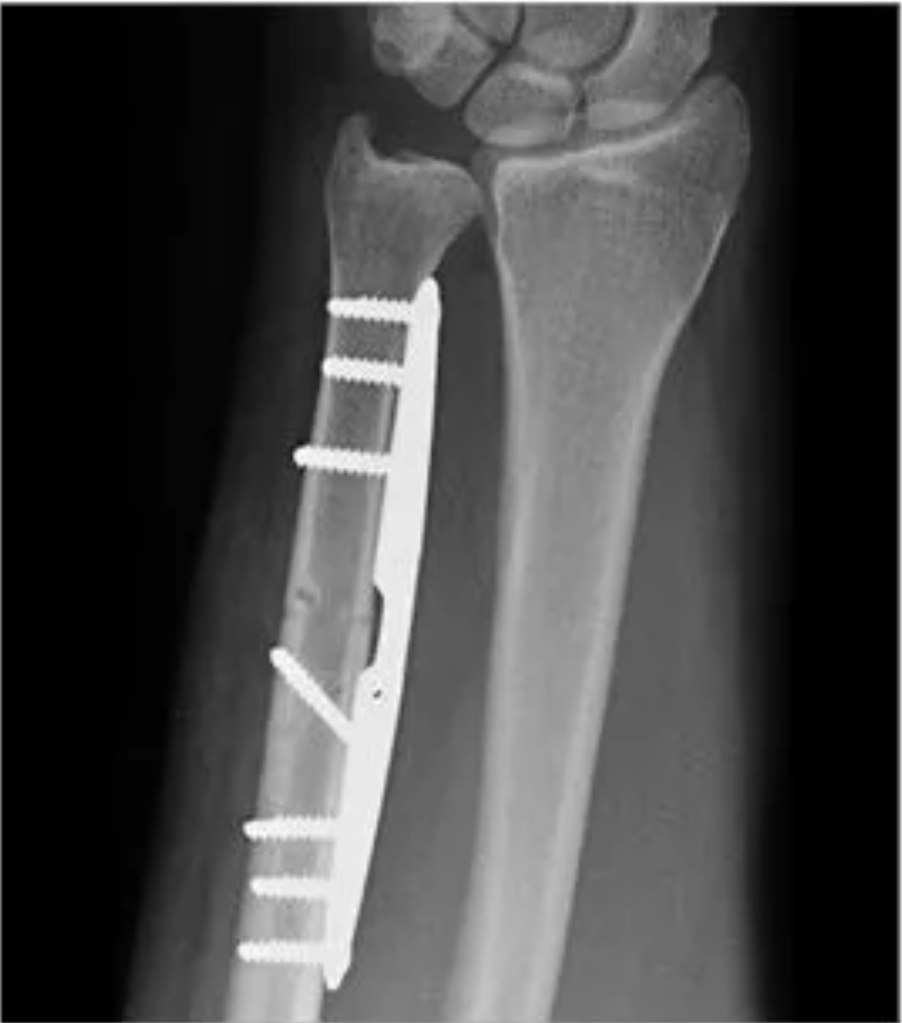 Ulna Compression Plate · Verkortings­osteotomie aanvullend beeld